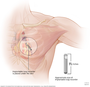 삽입형 루프 기록기 [출처] Mayo clinic